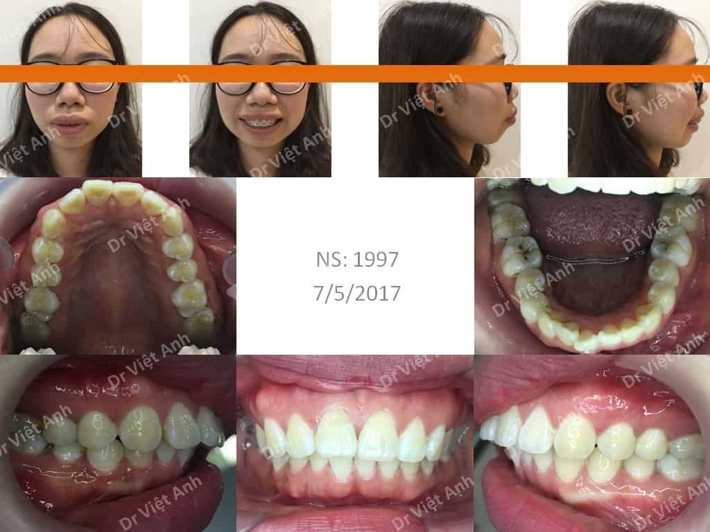 Niềng răng một ca hô xương nặng cải thiện 70% - Bs Việt Anh