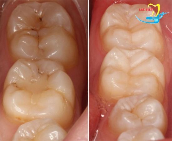 thuốc chữa sâu răng và kết quả trám răng sâu