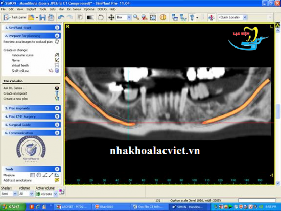 Khảo sát ống răng dưới trên phim CT CONE BAEM