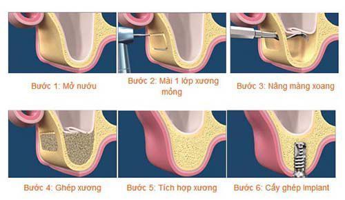 Quy trình đặt trụ implant tại nha khoa Lạc Việt