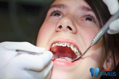Bật mí kinh nghiệm niềng răng cho hiệu quả TỐI ƯU NHẤT - nha khoa Paris
