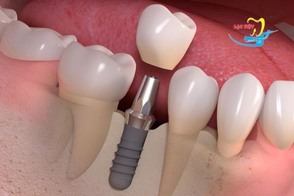 Trồng răng implant là gì và địa chỉ trồng răng implant uy tín - Nha khoa Lạc Việt