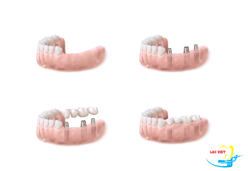 Các bước làm cầu răng sứ trên implant