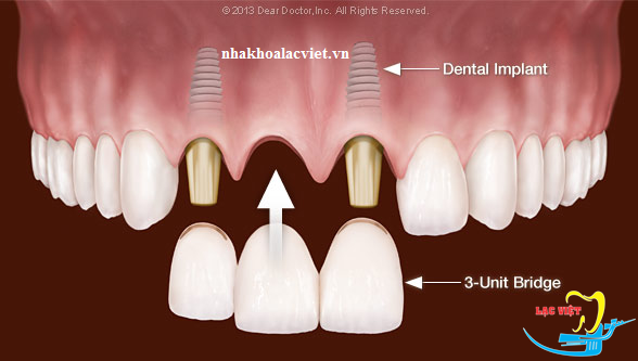 Làm cầu răng sứ trên implant - Nha khoa Lạc Việt