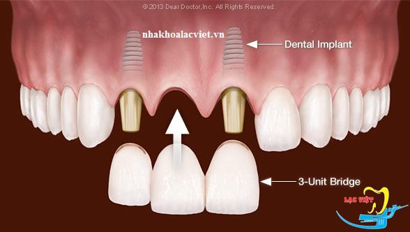 Khi mất ba răng cạnh nhau, có thể cân nhắc đặt 2 hoặc 3 implant tùy trường hợp