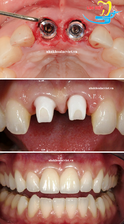 Các bước tiến hành làm răng implant cho răng cửa