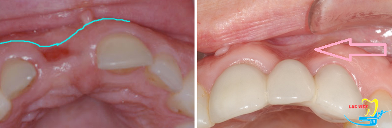 Làm răng implant cho răng cửa giúp đảm bảo tính thẩm mỹ