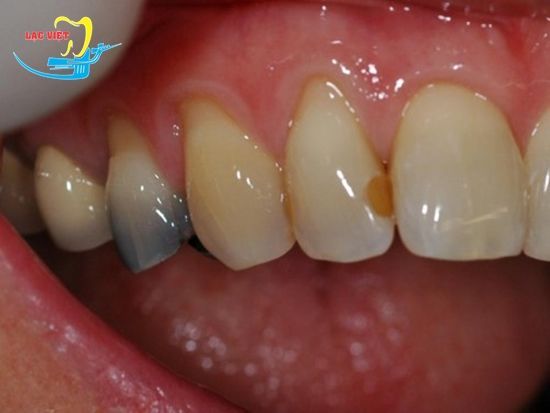 chữa sâu răng vĩnh viễn giai đoạn hình thành lỗ sâu răng