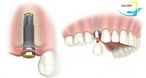 Một số lưu ý khi trồng răng Implant - Nha khoa Lạc Việt