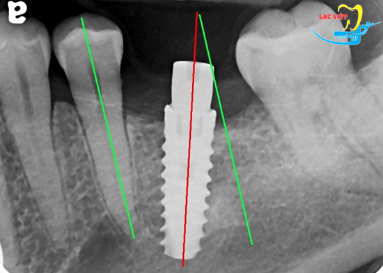 Đặt trụ bị lệch có thể dẫn tới tình trạng viêm quang implant