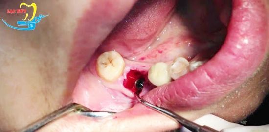 cách điều trị bệnh sâu răng bằng nhổ răng