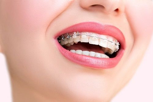 Niềng răng 1 hàm có được không, hiệu quả như thế nào? - nha khoa Paris