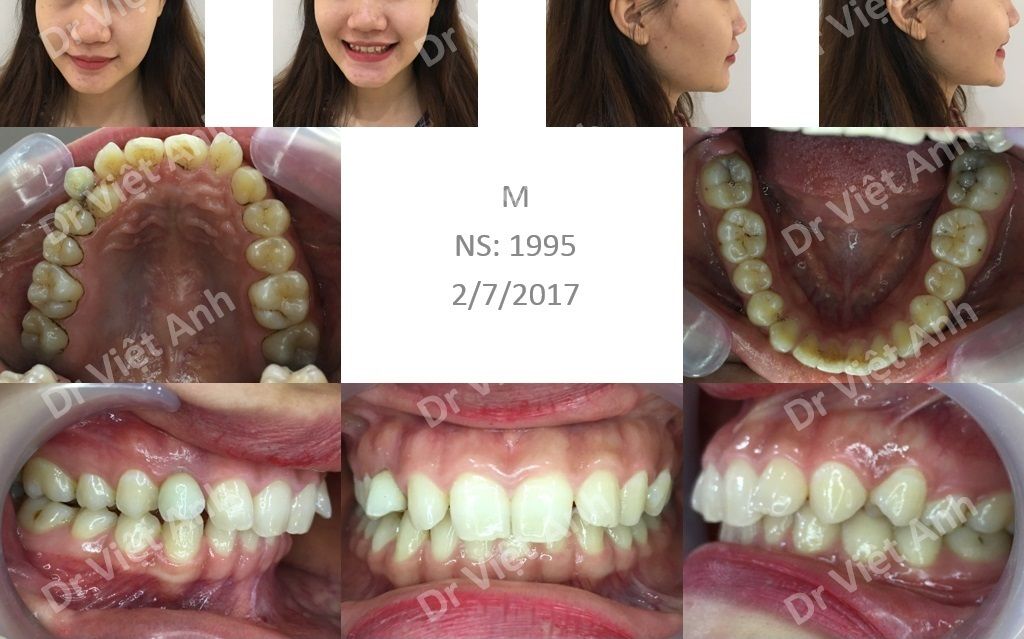 Niềng răng khấp khểnh, khớp cắn sâu, không nhổ răng  sau 10 tháng - Bác sĩ Việt Anh