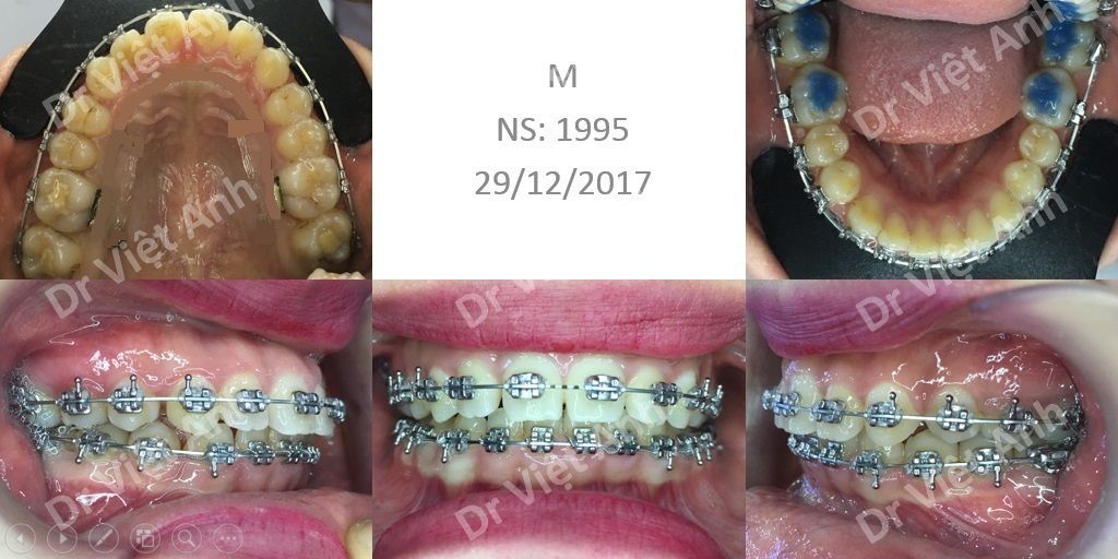 nieng rang 10 thang 2