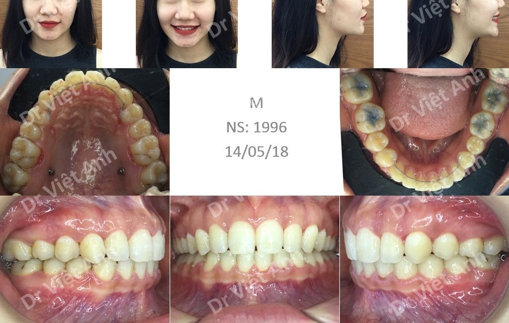 nieng rang 10 thang 3