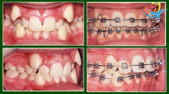 Chi tiết niềng răng khểnh như thế nào tại nha khoa uy tín - Nha khoa Lạc Việt