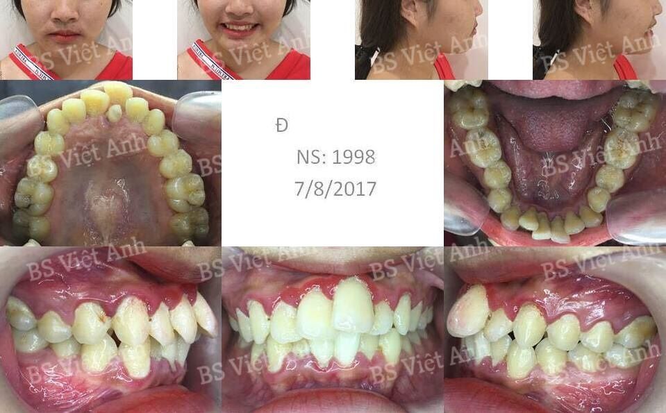Niềng răng khấp khểnh sau 7 tháng, không nhổ răng