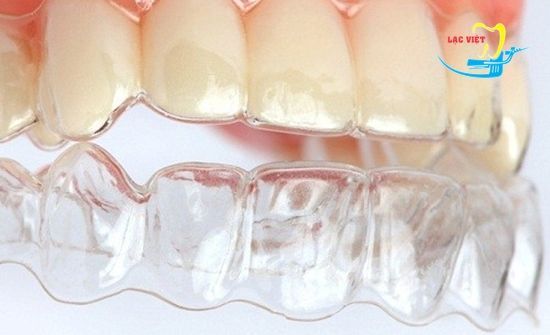 Niềng răng không mắc cài 3D Speed – Chỉnh nha bí mật – Thẩm mỹ toàn diện - nha khoa Paris