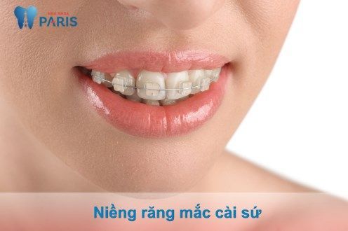 Niềng răng mắc cài sứ – Giải pháp thẩm mỹ răng Toàn Diện! - nha khoa Paris