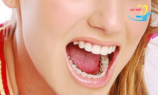 giá chỉnh răng móm phụ thuộc vào tình trạng sai lệch