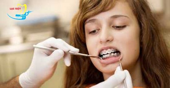 Niềng răng móm có đau không – Giải đáp từ chuyên gia nha khoa - Nha khoa Lạc Việt