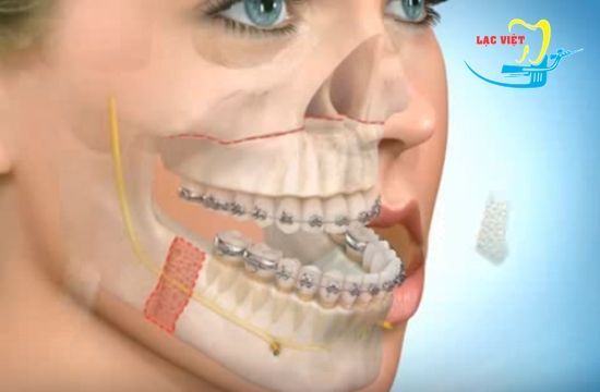 Phẫu thuật chỉnh răng móm là gì