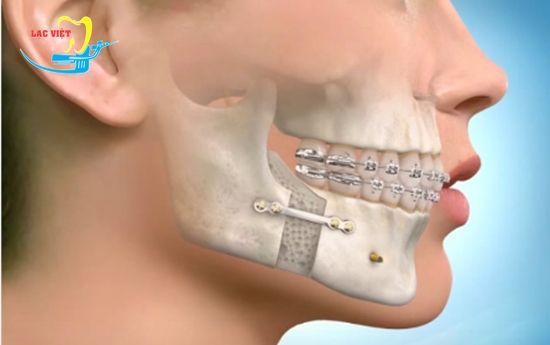 Phẫu thuật là phương pháp chỉnh răng móm hiệu quả