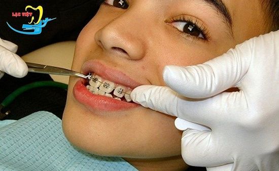 Chuyên gia nha khoa tư vấn: Phương pháp chỉnh răng móm hiệu quả - Nha khoa Lạc Việt