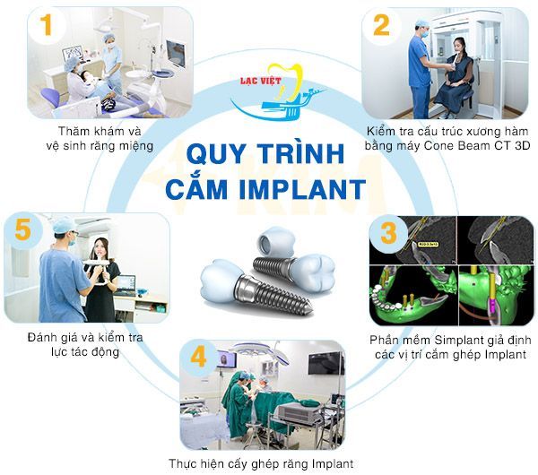 Quy Trình Cắm Ghép Răng Implant Đúng Chuẩn của Bộ Y Tế - Nha khoa Lạc Việt