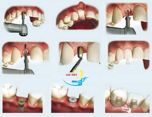 Quy trình trồng răng implant uy tín
