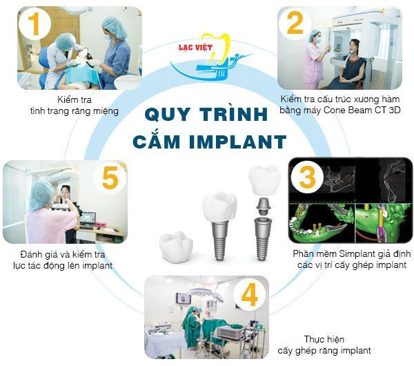 Quy trình cắm implant theo tiêu chuẩn quốc tế