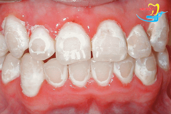 cách chữa sâu răng vĩnh viễn với răng chớm sâu