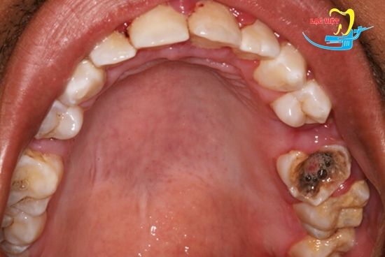 Vật liệu trám răng hàm trên thường được sử dụng là gì? 
