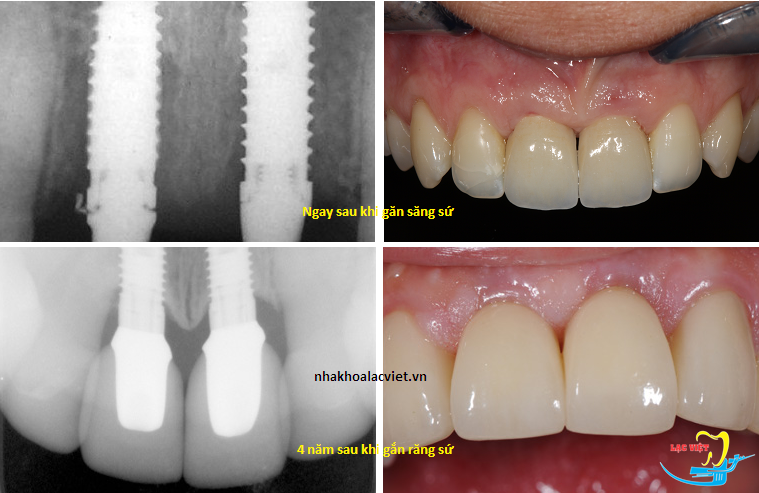 Làm sao để cho răng implant tồn tại suốt đời? - Nha khoa Lạc Việt