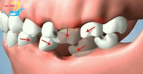 Sau khi nhổ răng bao lâu thì trồng răng giả là tốt nhất? - Nha khoa Lạc Việt