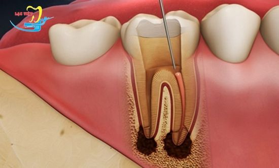 làm thế nào để hết sâu răng khi đã viêm tủy