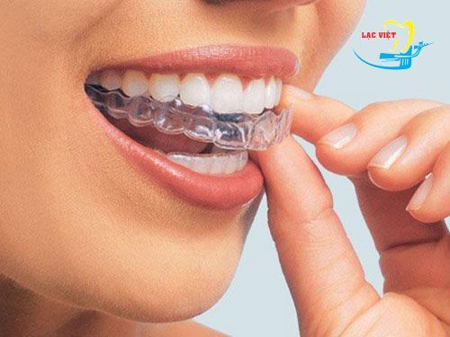 Tẩy trắng răng bằng máng- Cách tẩy trắng răng hiệu quả và an toàn nhất 2017 - Nha khoa Lạc Việt