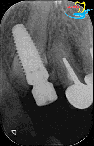 Khoan vào chân răng bên cạnh là một trong những tai biến và biến chứng trong lúc cấy ghép implant nha khoa