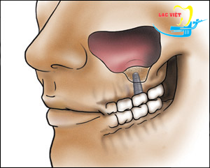 Thủng xoang hàm là một trong những tai biến và biến chứng trong lúc cấy ghép implant nha khoa.