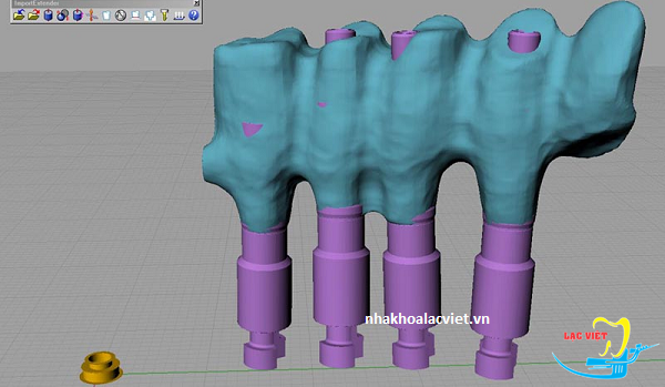 Thiết kế sườn răng sứ răng implant tồn tại suốt đời 