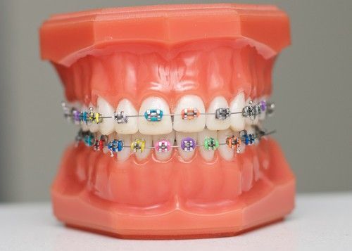 Thông tin từ a – z về niềng răng mắc cài kim loại - nha khoa Paris