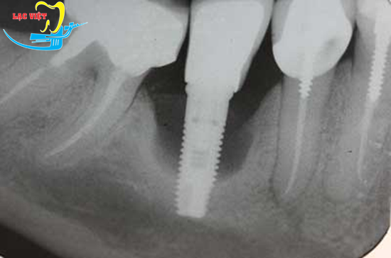 Răng sứ kém chất lượng là một trong những nguyên nhân dẫn tới viêm quang implant