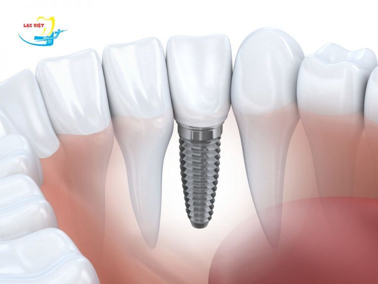 Trụ implant đóng vai trò như một chân răng thực sự trên cung hàm