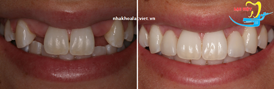 Trồng răng implant và trồng răng sứ khác nhau như thế nào? - Nha khoa Lạc Việt