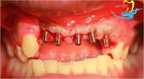 Trồng răng implant có nguy hiểm không nếu xảy ra biến chứng?