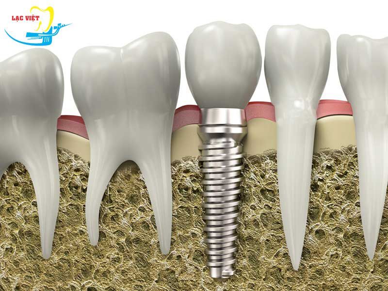 Trồng răng implant có nguy hiểm không khi có sự hỗ trợ của công nghệ Implant 4S?