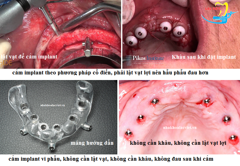 So sánh kỹ thuật vi phẫu với phương pháp cổ điển trồng răng rẻ tại Hà Nội