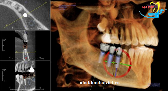 Phân tích hình ảnh trước khi cấy răng trồng răng implant ở đâu tốt nhất tại Hà Nội ở Nha khoa Lạc Việt