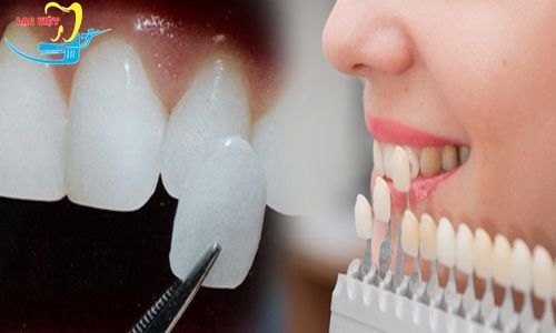 trồng răng khểnh giá bao nhiêu phụ thuộc vào loại răng sứ lựa chọn để trồng răng khểnh