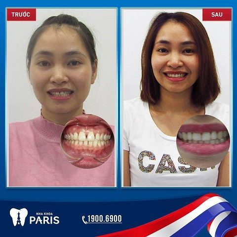 “Chiêm Ngưỡng” kết quả trước và sau khi niềng răng đẹp cỡ nào - nha khoa Paris